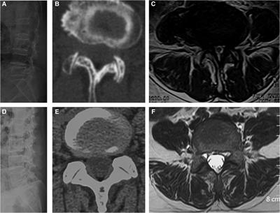 Radiographic risk factors for degenerative lumbar spondylolisthesis: A comparison with healthy control subjects